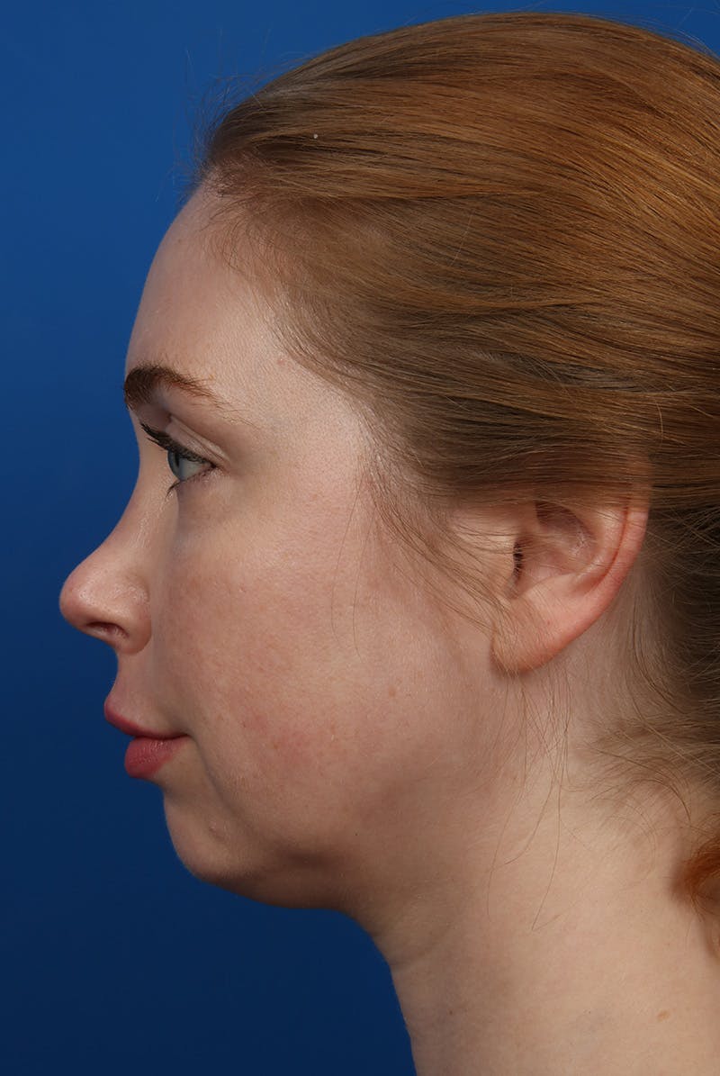 Jawline Before & After Gallery - Patient 129280 - Image 9