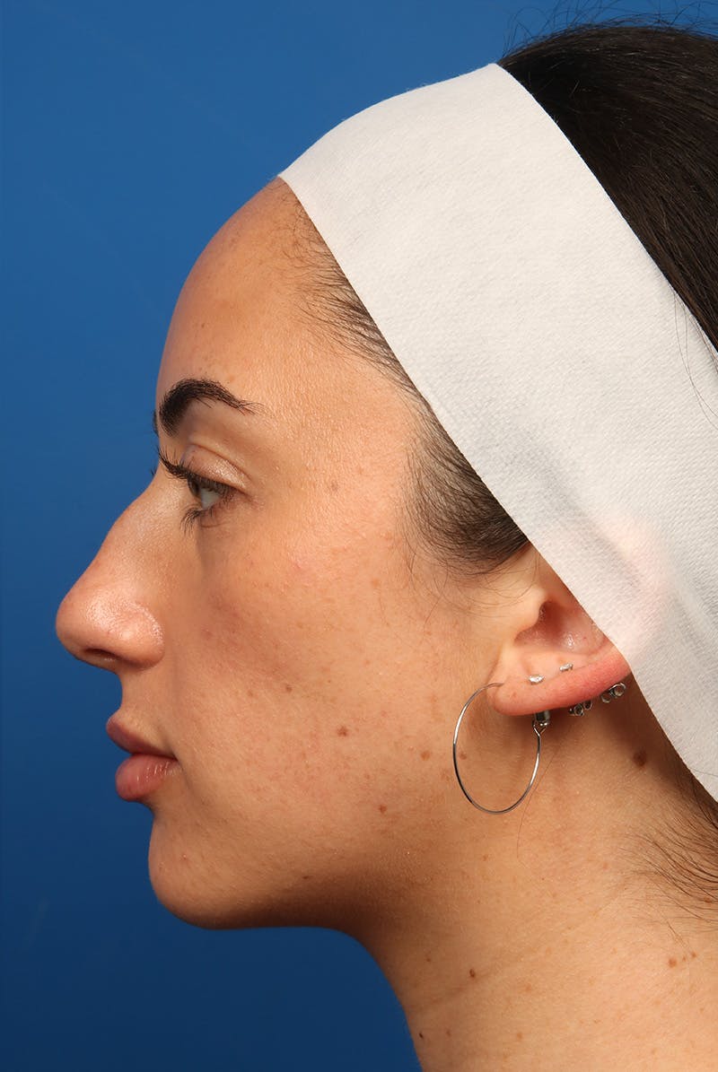 Tear Troughs Before & After Gallery - Patient 349942 - Image 9