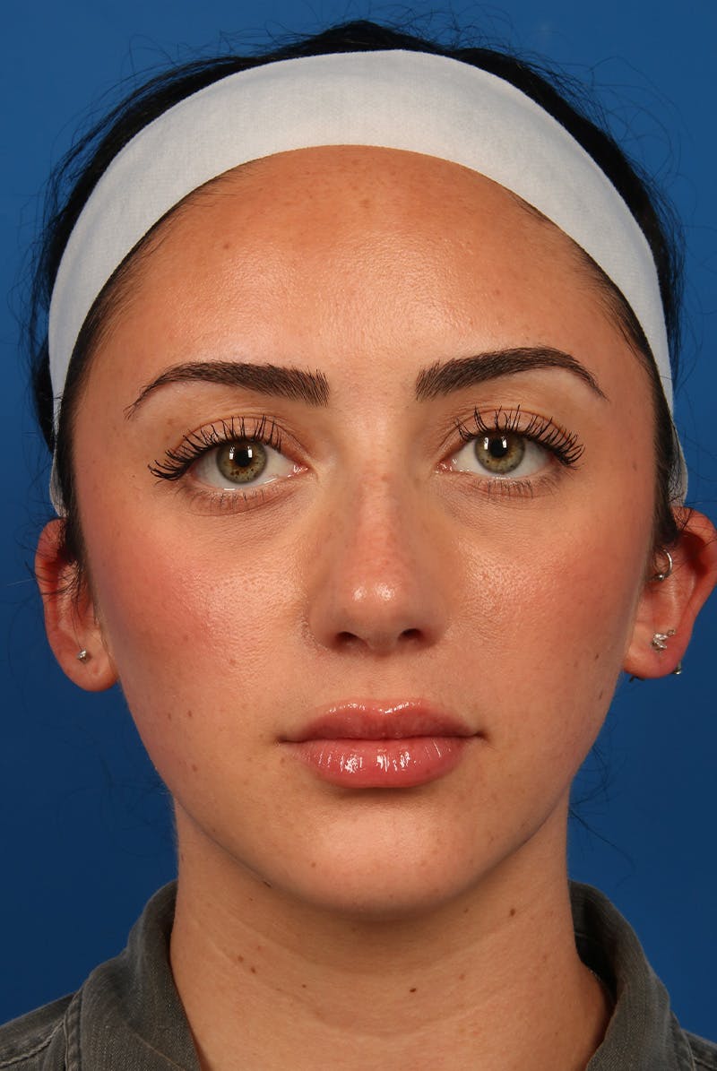 Tear Troughs Before & After Gallery - Patient 349942 - Image 2