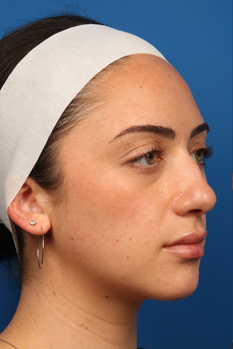 Tear Troughs Before & After Gallery - Patient 349942 - Image 3