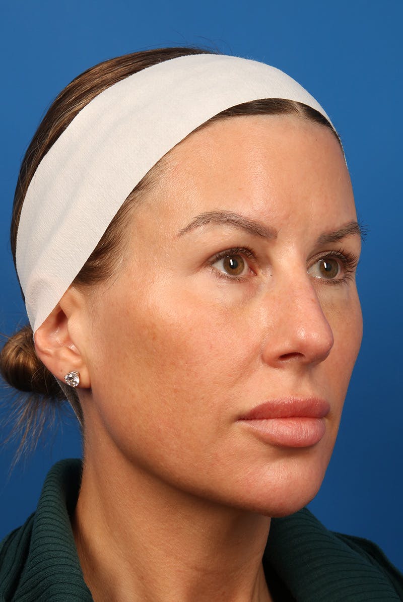 Tear Troughs Before & After Gallery - Patient 399893 - Image 3