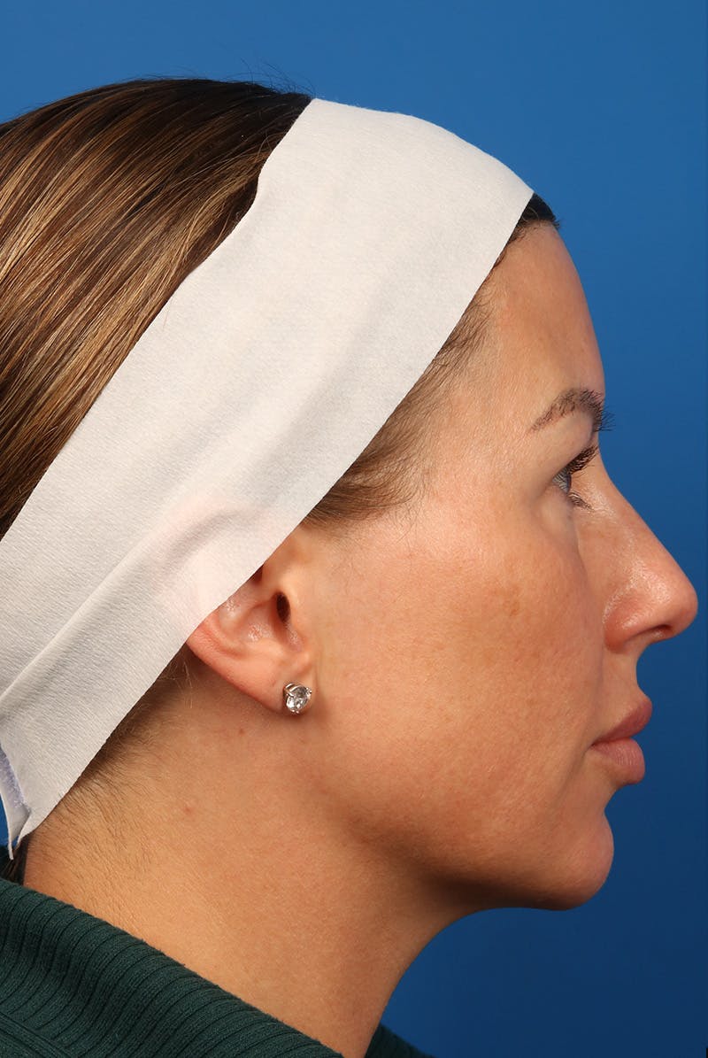 Tear Troughs Before & After Gallery - Patient 399893 - Image 5