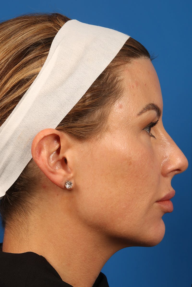 Tear Troughs Before & After Gallery - Patient 399893 - Image 6