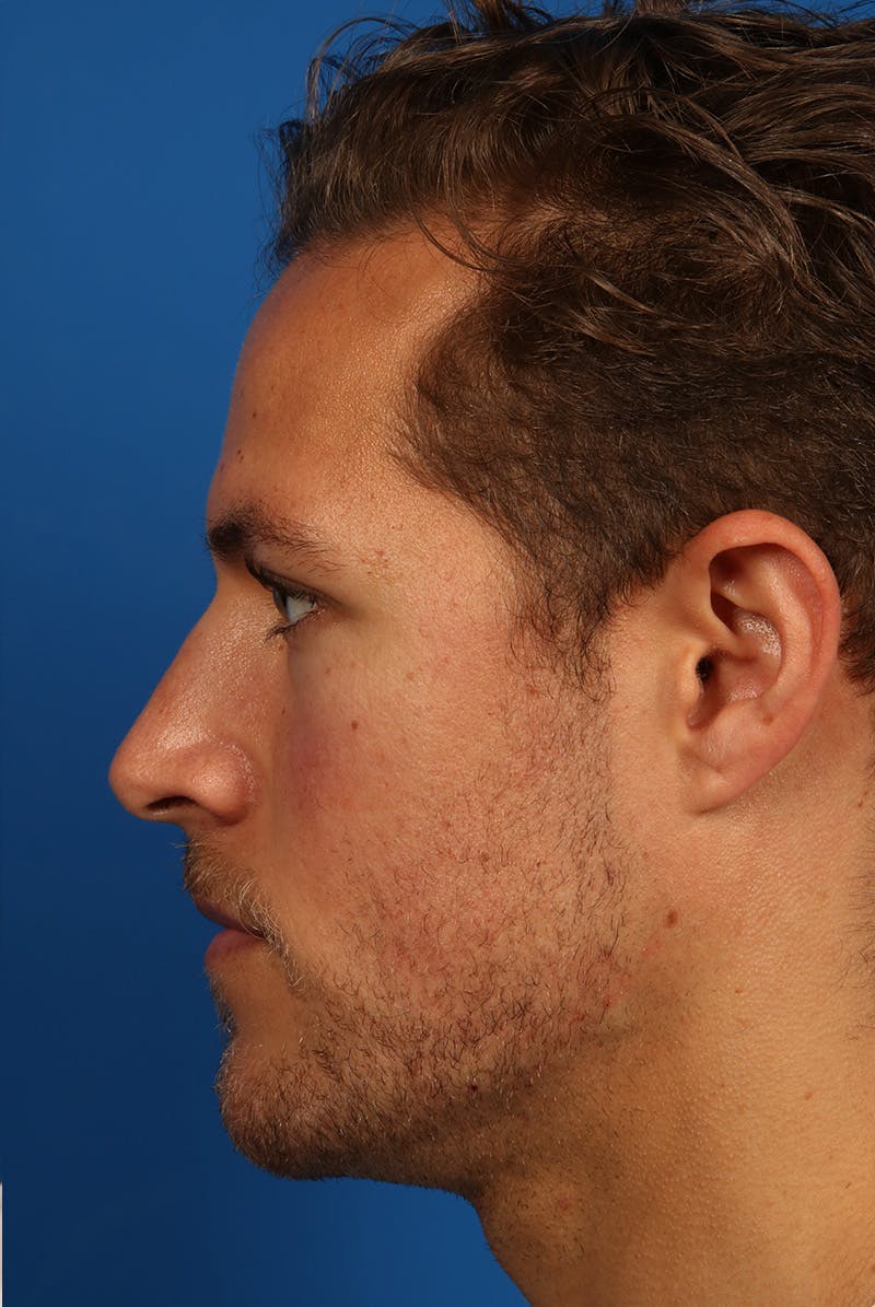 Chin Before & After Gallery - Patient 259584 - Image 6