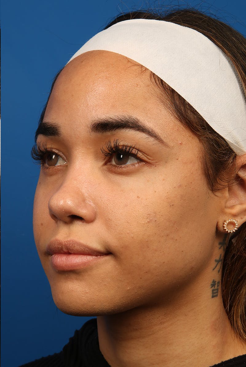 Tear Troughs Before & After Gallery - Patient 301103 - Image 7