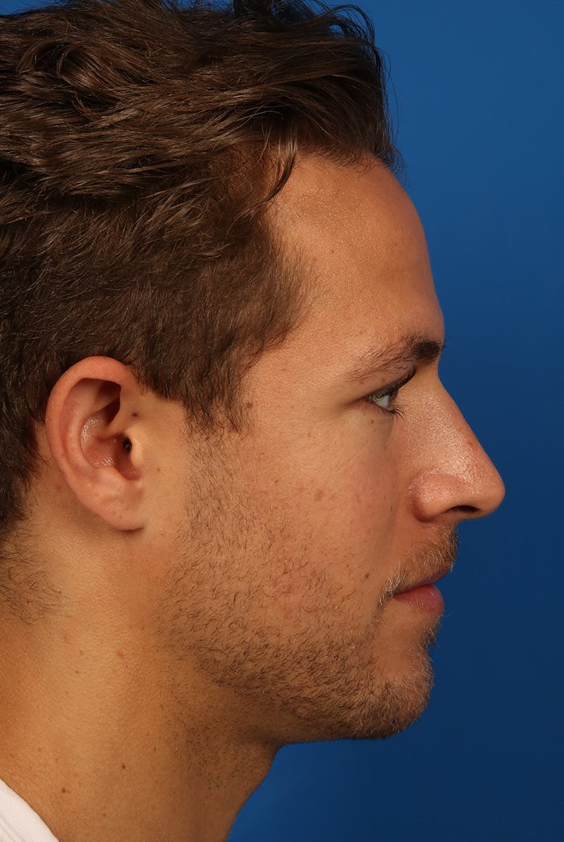 Chin Before & After Gallery - Patient 259584 - Image 7