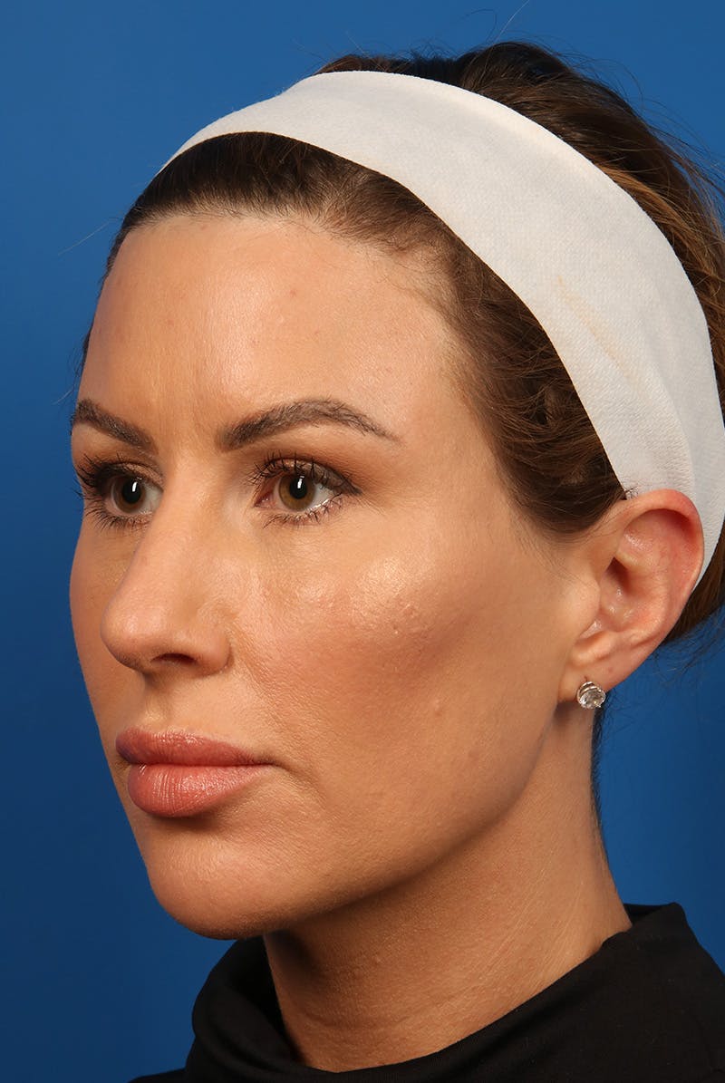 Tear Troughs Before & After Gallery - Patient 399893 - Image 8