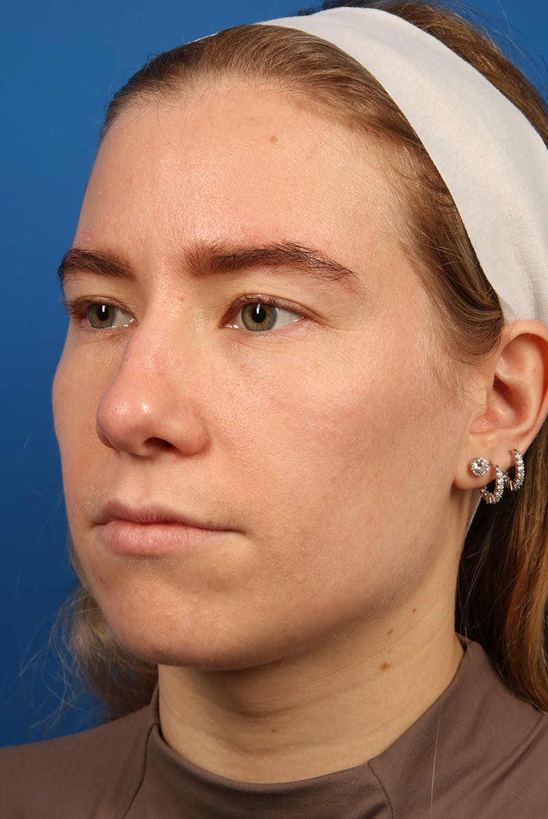 Nose Before & After Gallery - Patient 279270 - Image 8