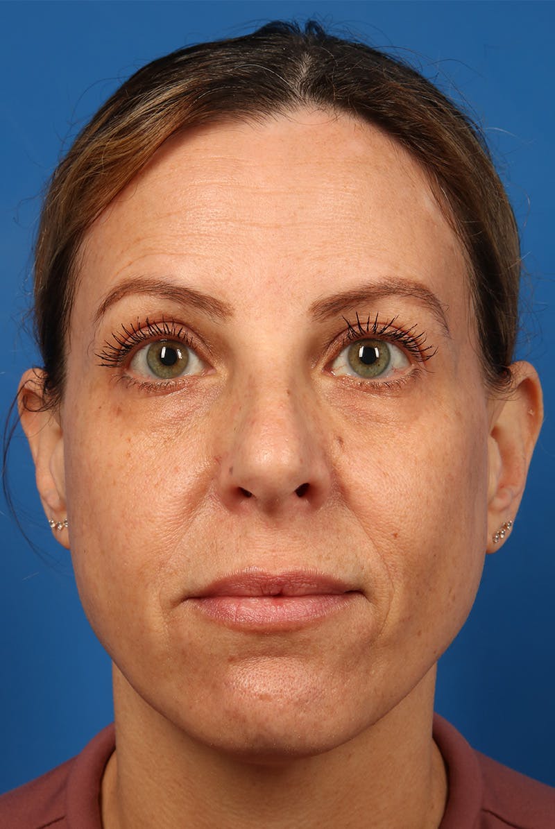 Full Face Before & After Gallery - Patient 284190 - Image 1