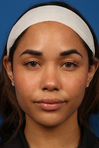 Jawline Before & After Gallery - Patient 360747 - Image 2