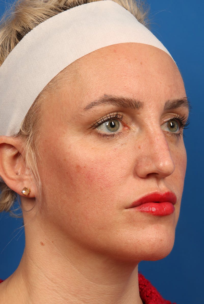 Nose Before & After Gallery - Patient 463536 - Image 3