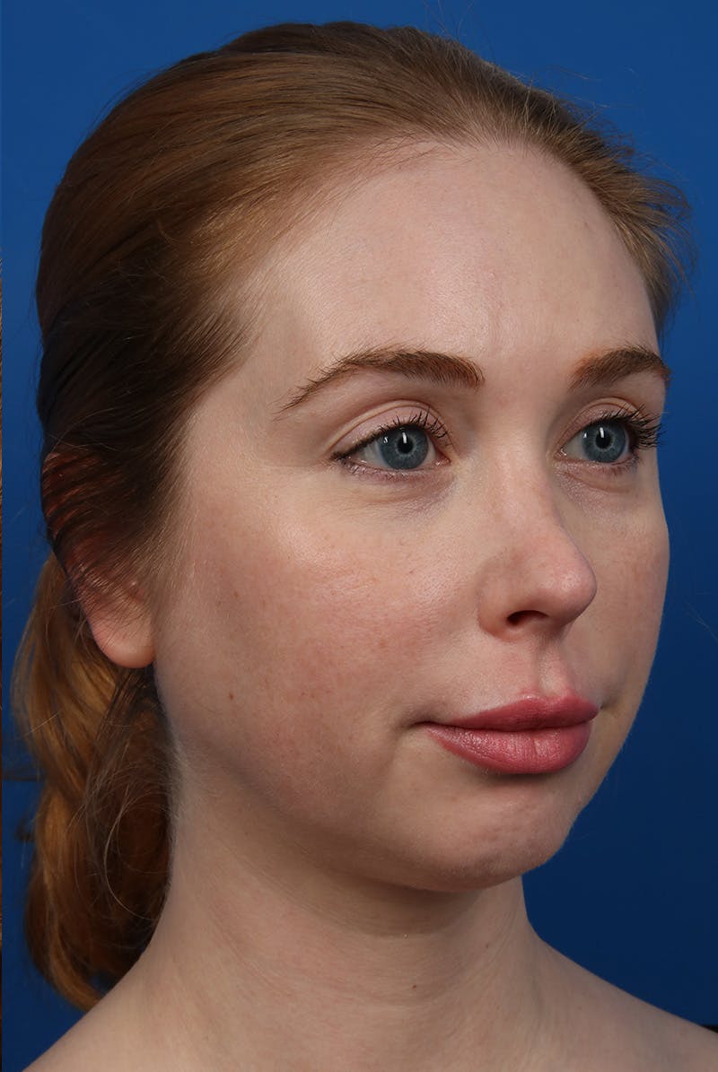 Jawline Before & After Gallery - Patient 129280 - Image 3