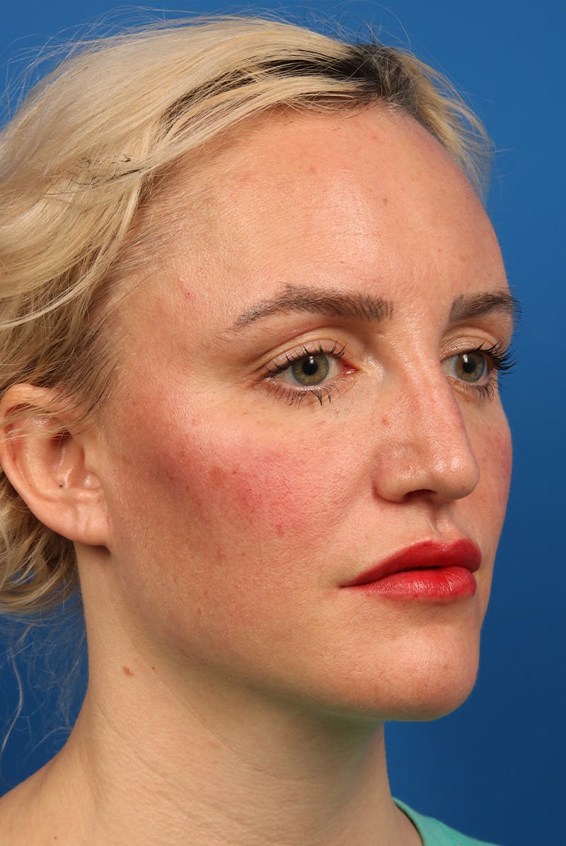 Nose Before & After Gallery - Patient 463536 - Image 4