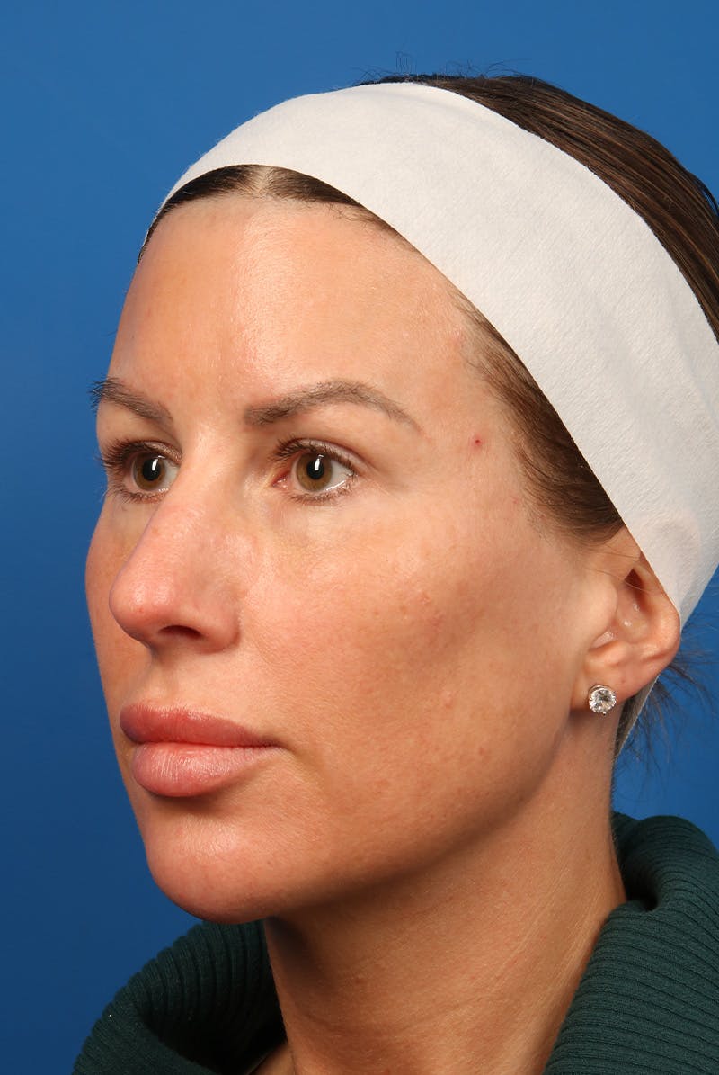 Tear Troughs Before & After Gallery - Patient 399893 - Image 7