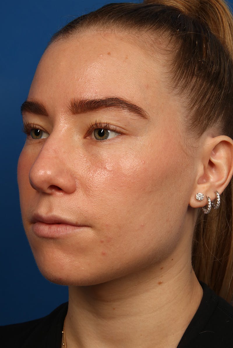 Nose Before & After Gallery - Patient 279270 - Image 7