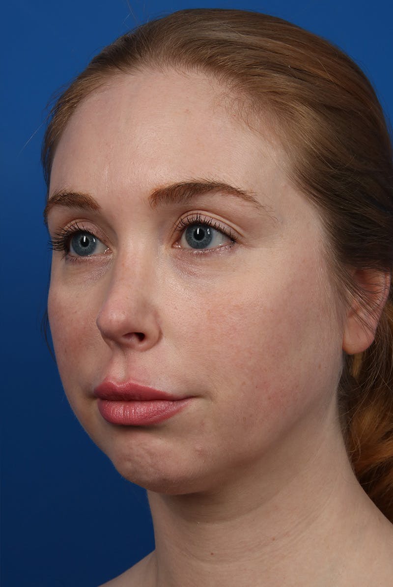 Jawline Before & After Gallery - Patient 129280 - Image 7