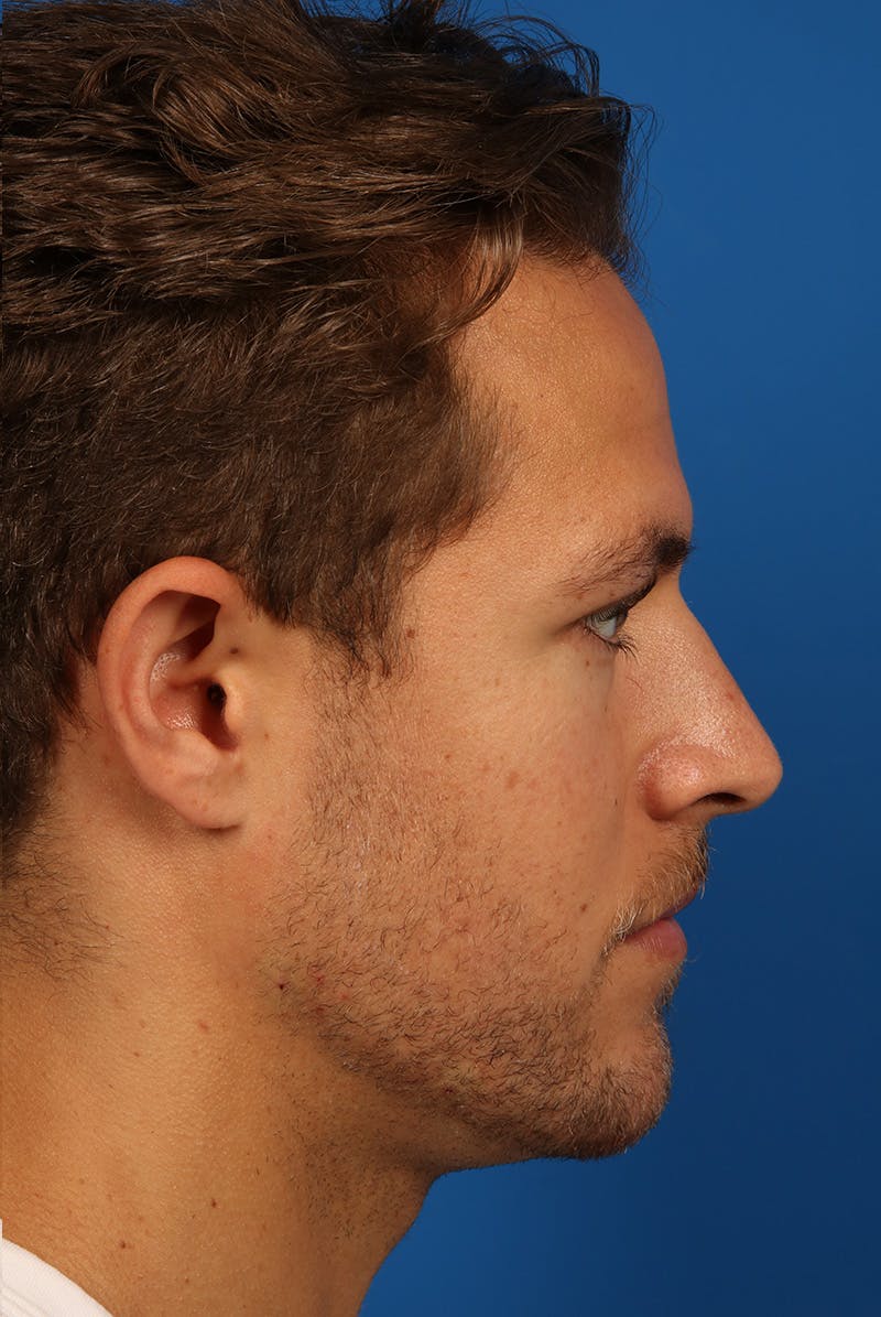 Chin Before & After Gallery - Patient 259584 - Image 8