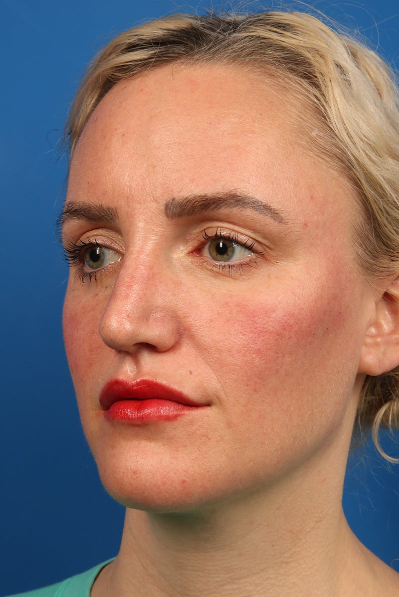 Nose Before & After Gallery - Patient 463536 - Image 8