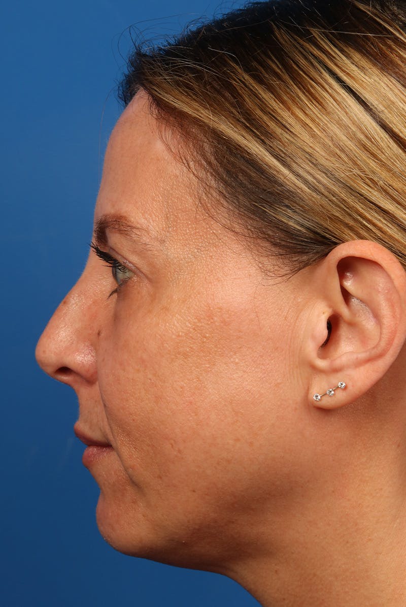 Full Face Before & After Gallery - Patient 284190 - Image 9