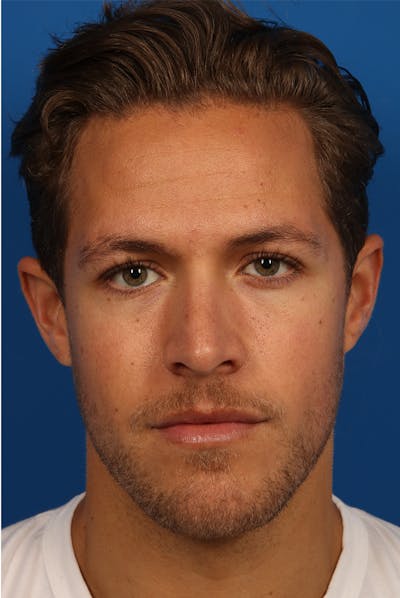 Chin Before & After Gallery - Patient 259584 - Image 1