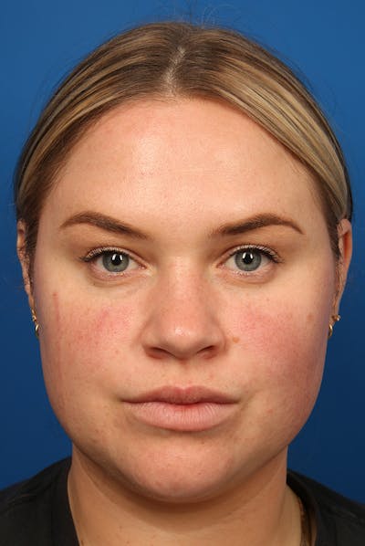 Nose Before & After Gallery - Patient 251525 - Image 1