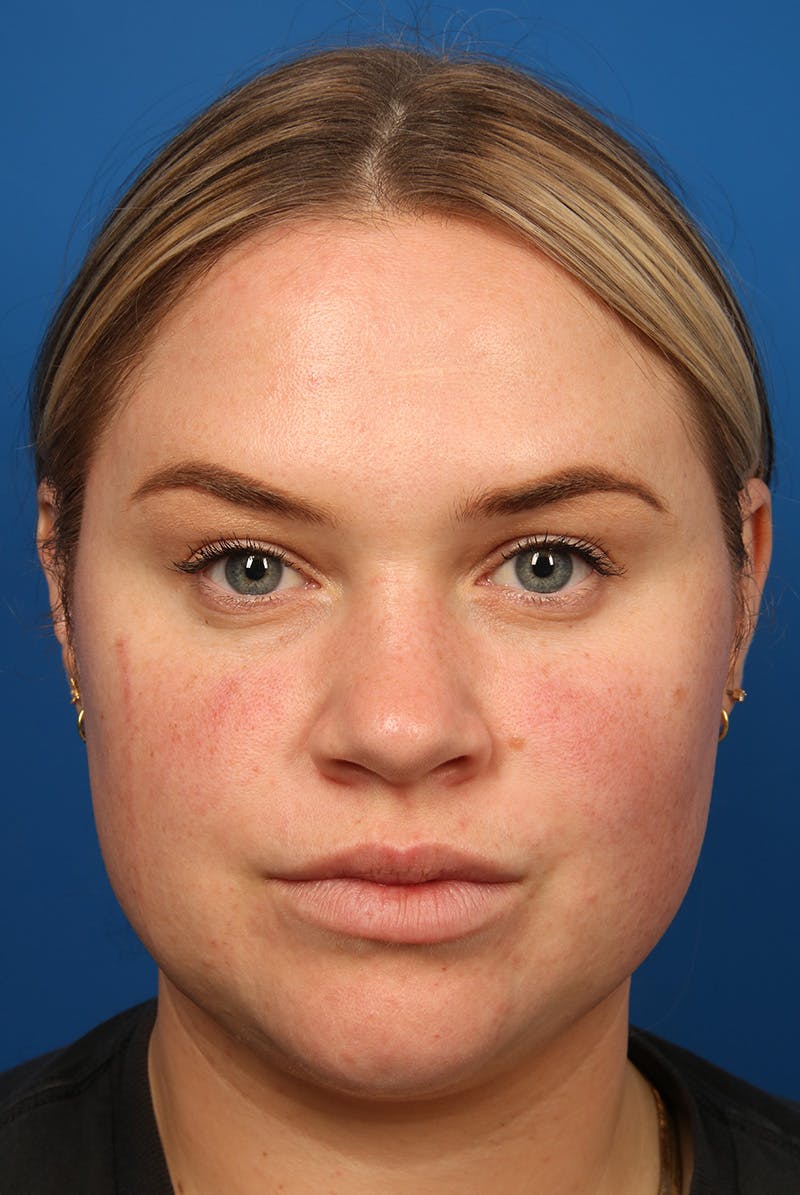 Tear Troughs Before & After Gallery - Patient 216553 - Image 1