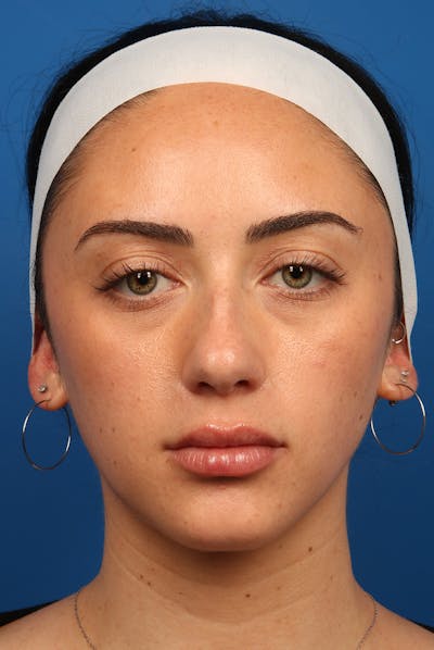 Jawline Before & After Gallery - Patient 252448 - Image 2