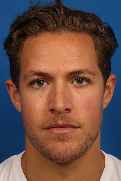 Chin Before & After Gallery - Patient 259584 - Image 2