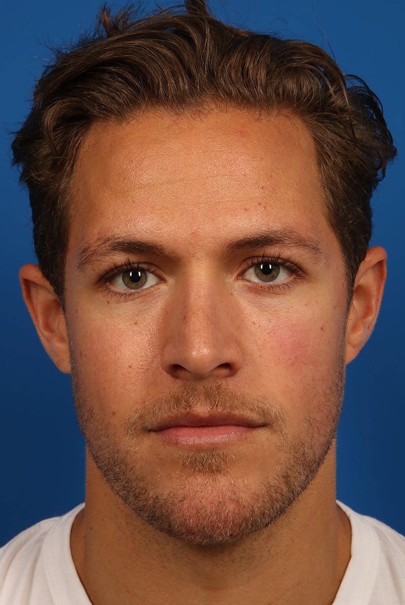 Chin Before & After Gallery - Patient 259584 - Image 2