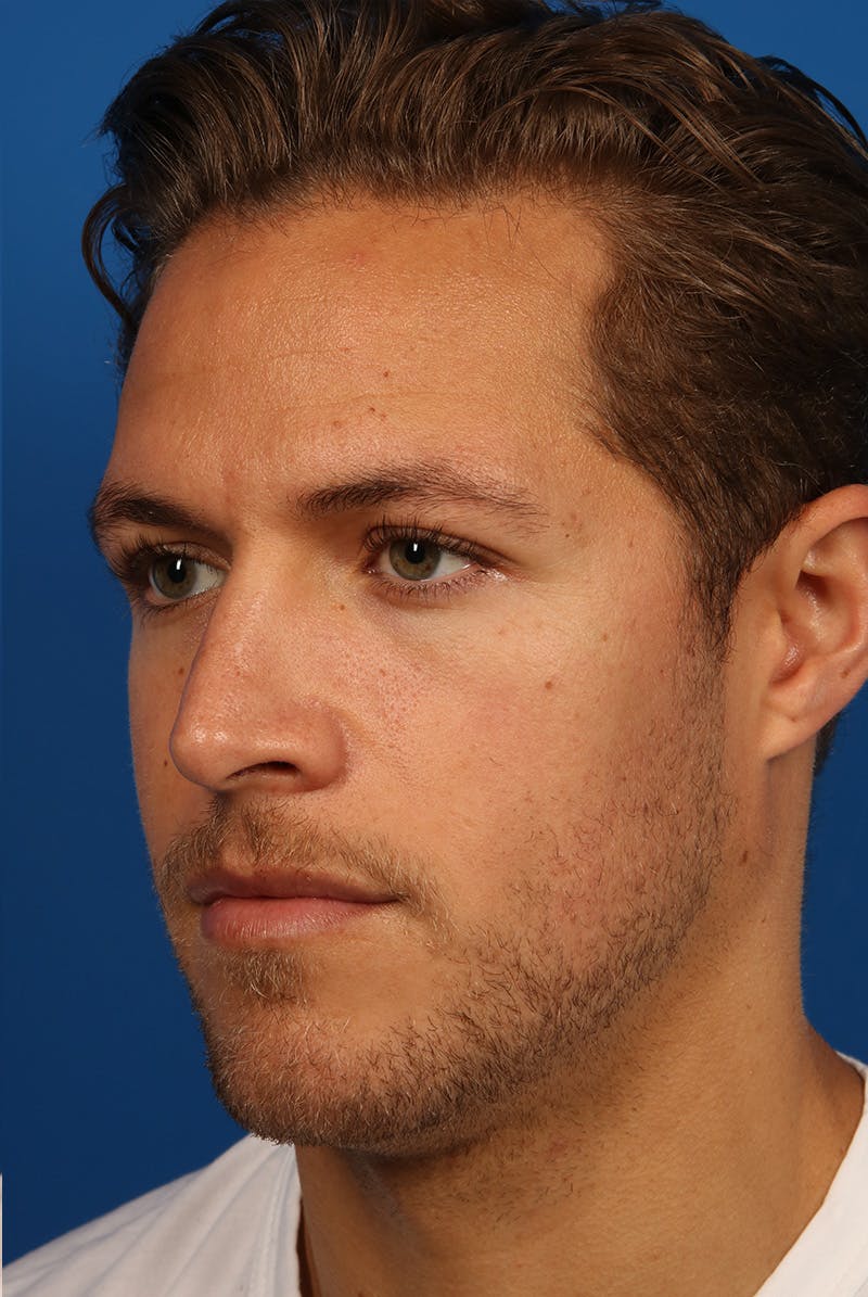 Chin Before & After Gallery - Patient 259584 - Image 3