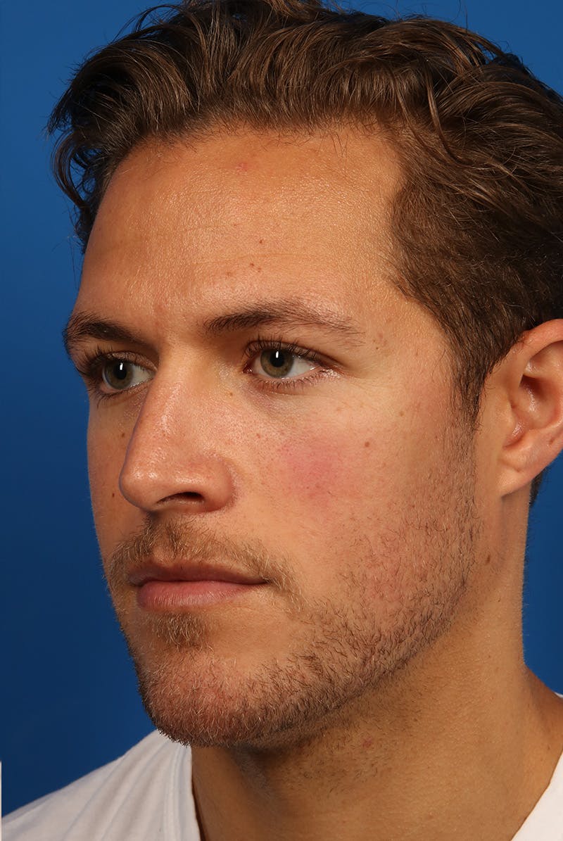 Chin Before & After Gallery - Patient 259584 - Image 4