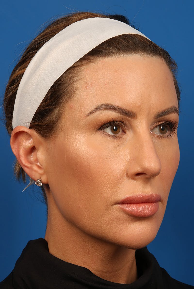 Tear Troughs Before & After Gallery - Patient 399893 - Image 4