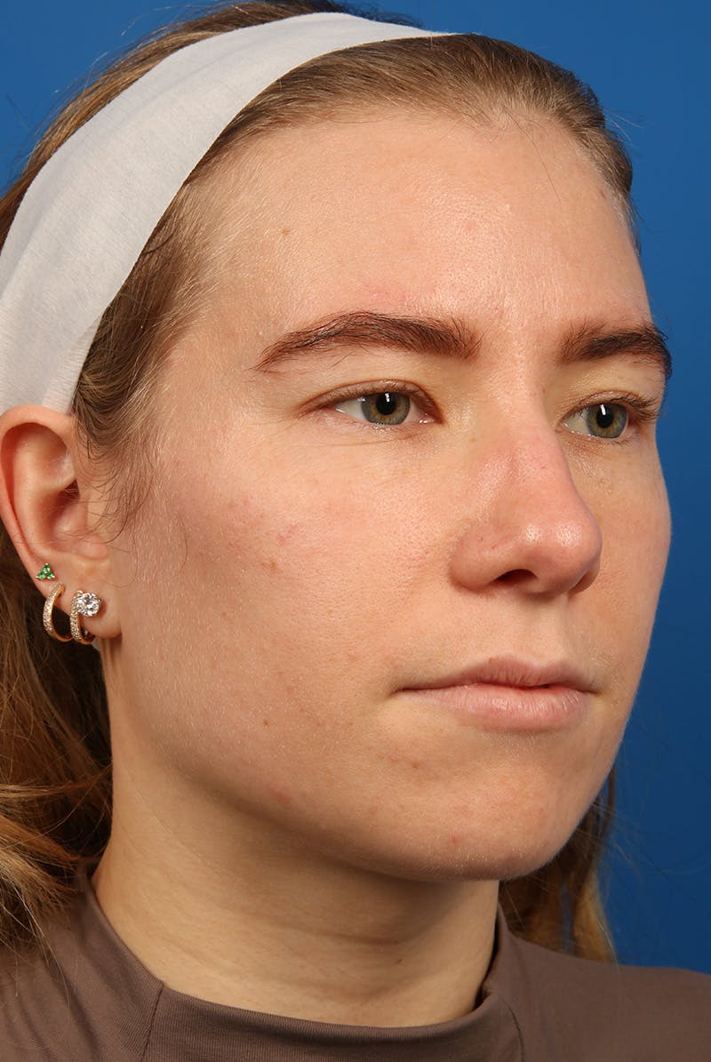 Nose Before & After Gallery - Patient 279270 - Image 4