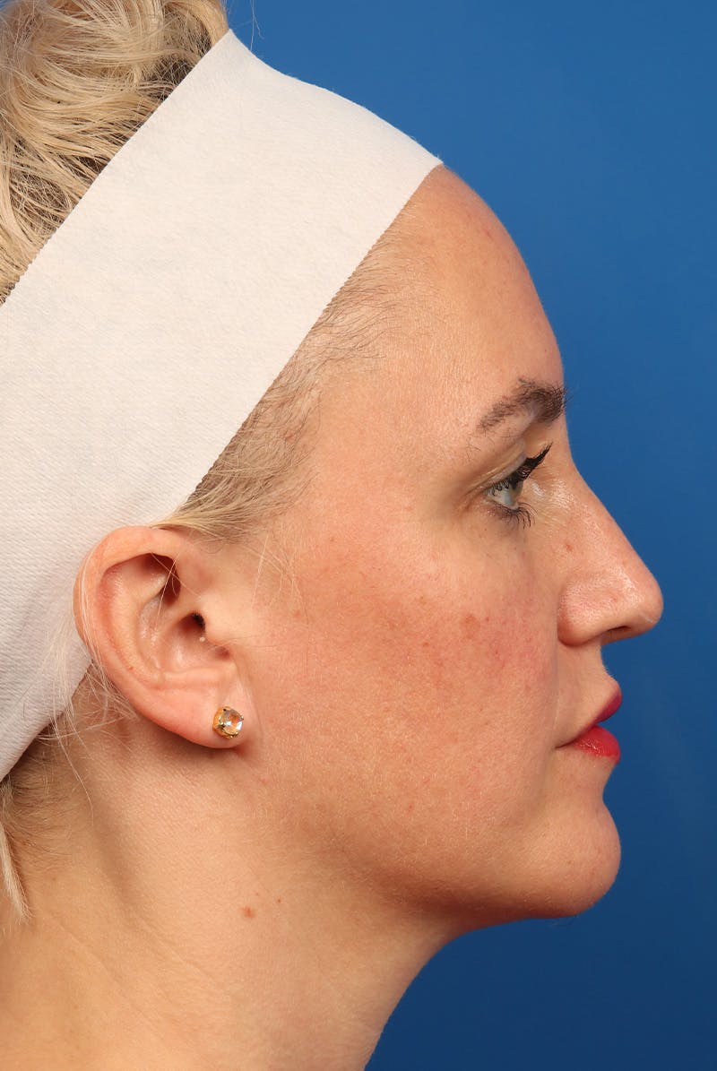 Nose Before & After Gallery - Patient 463536 - Image 5