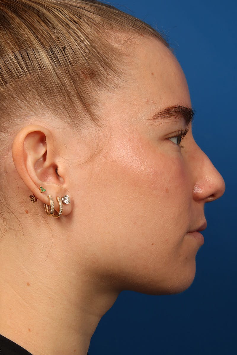 Nose Before & After Gallery - Patient 279270 - Image 5