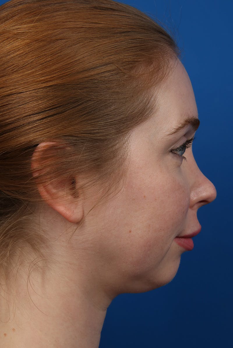 Jawline Before & After Gallery - Patient 129280 - Image 5
