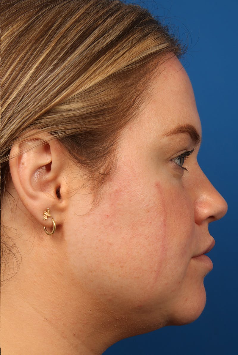 Tear Troughs Before & After Gallery - Patient 216553 - Image 6