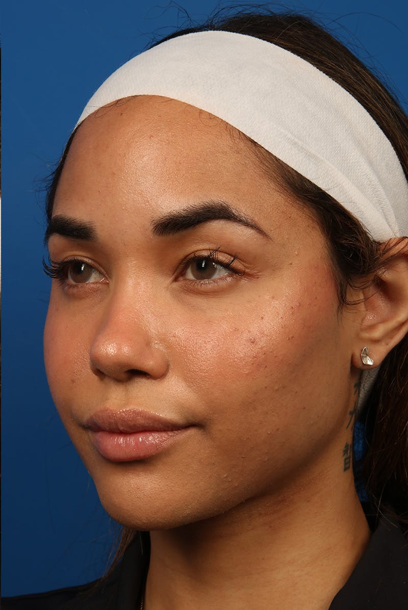 Tear Troughs Before & After Gallery - Patient 301103 - Image 8