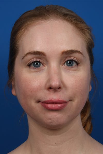 Jawline Before & After Gallery - Patient 129280 - Image 1