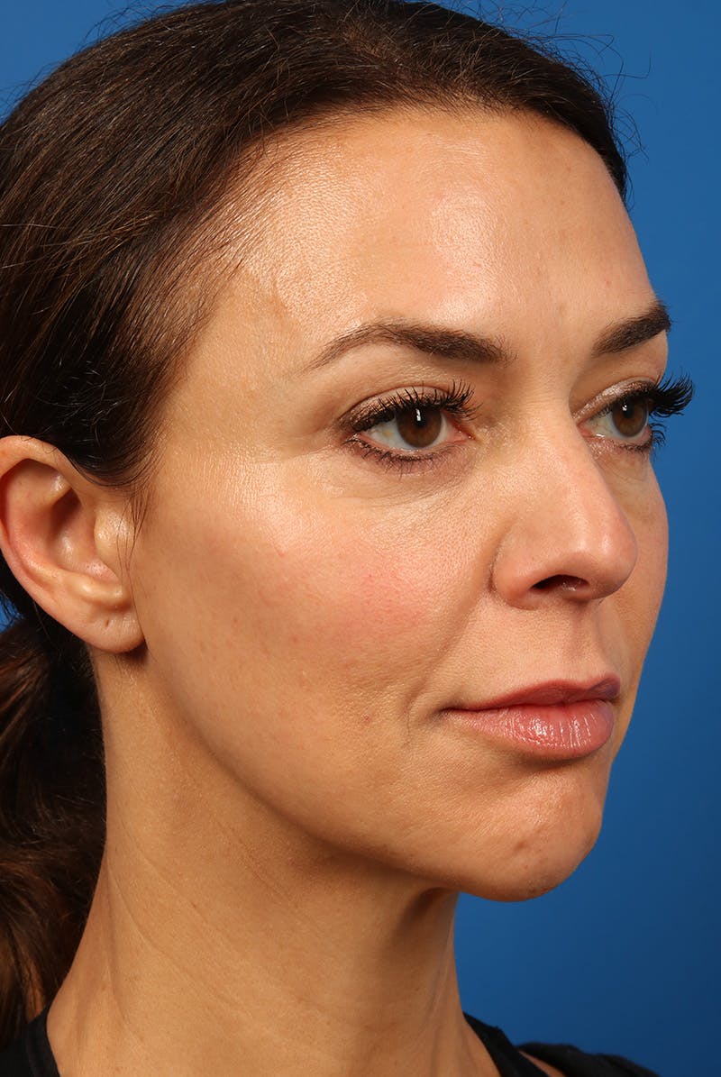 Cheeks Before & After Gallery - Patient 170223 - Image 4