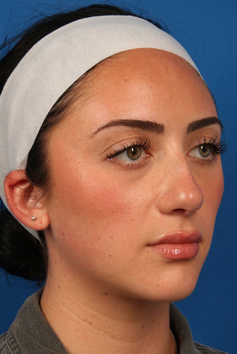 Tear Troughs Before & After Gallery - Patient 349942 - Image 4