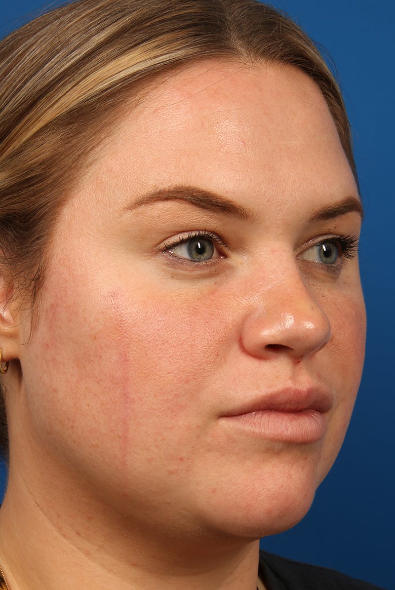 Tear Troughs Before & After Gallery - Patient 216553 - Image 4