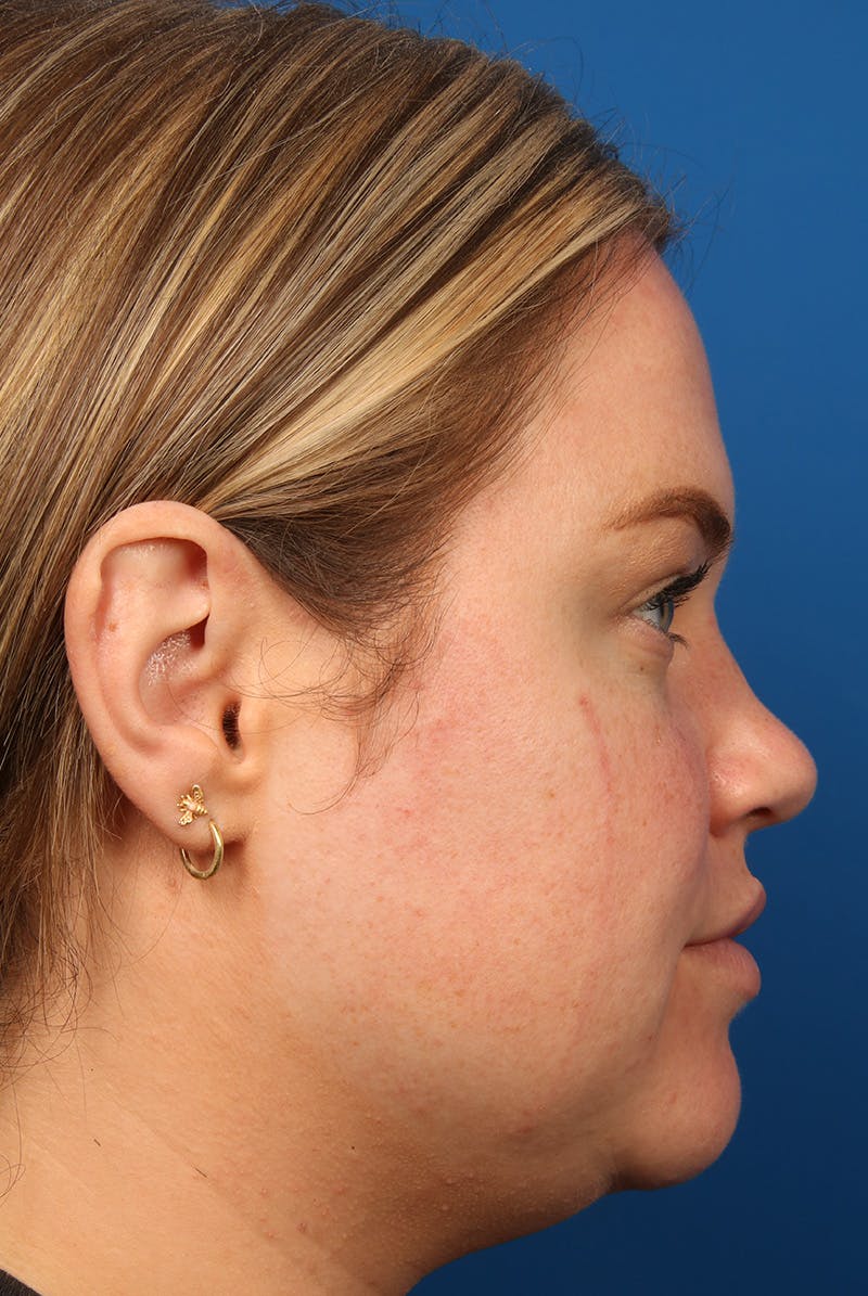 Tear Troughs Before & After Gallery - Patient 216553 - Image 5