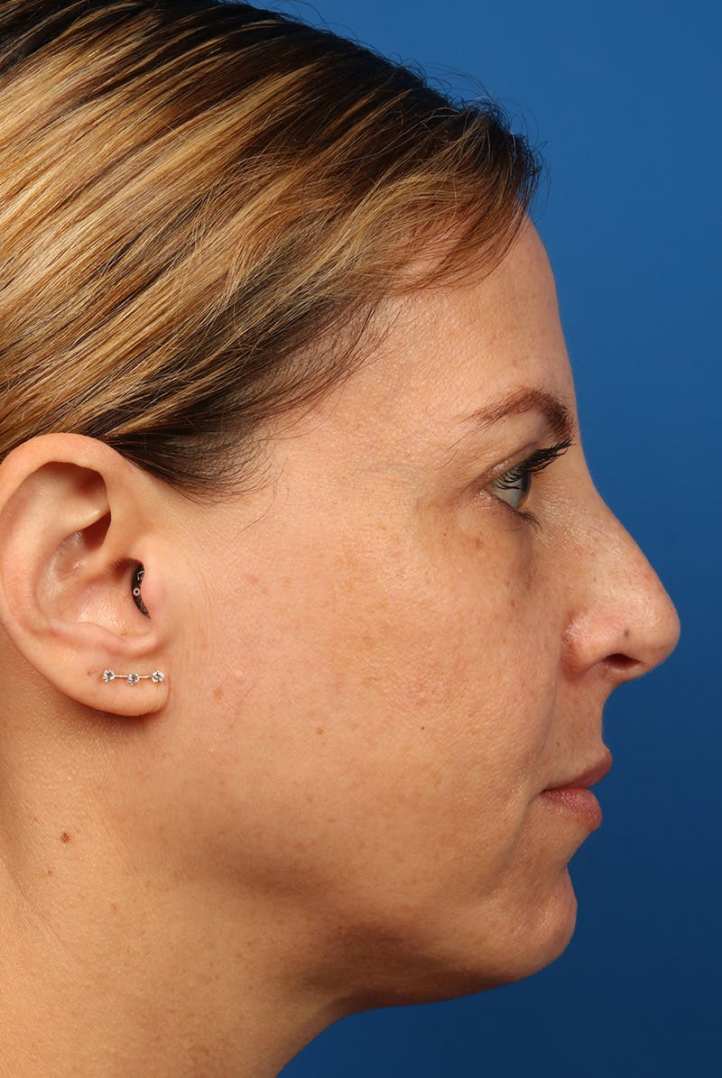 Full Face Before & After Gallery - Patient 284190 - Image 5