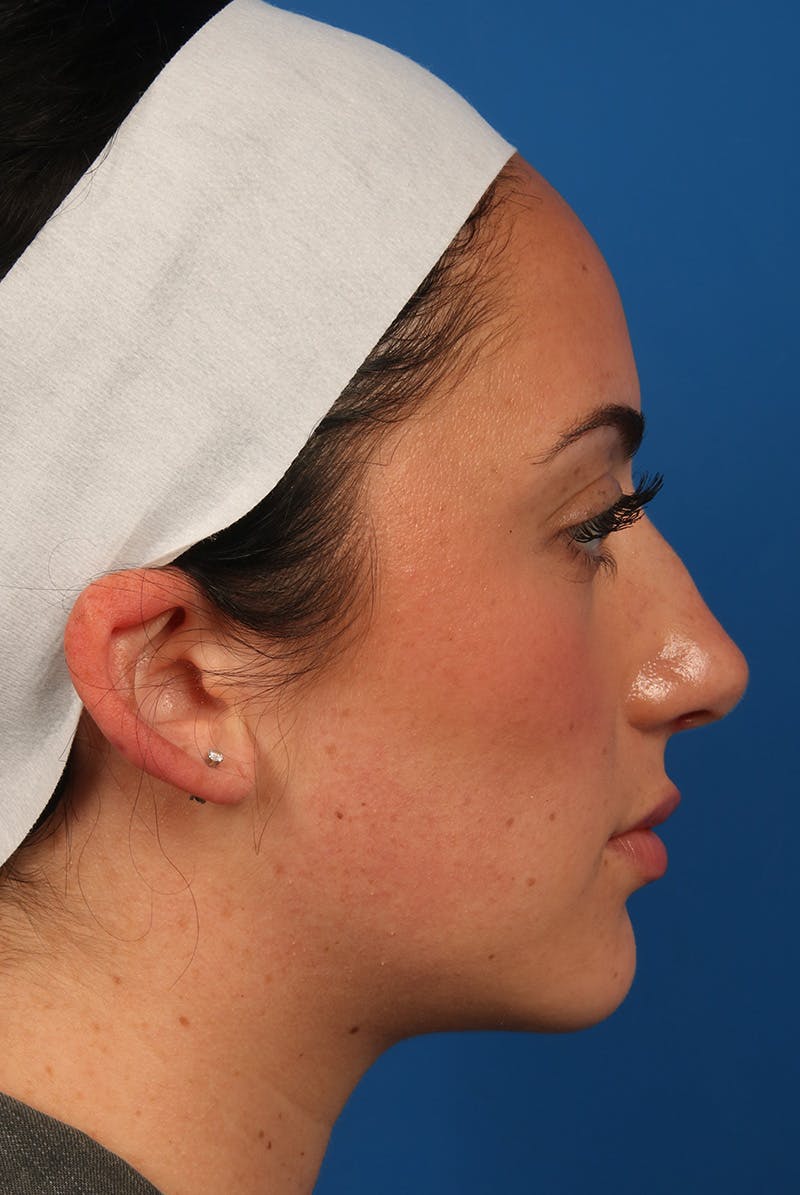 Tear Troughs Before & After Gallery - Patient 349942 - Image 6