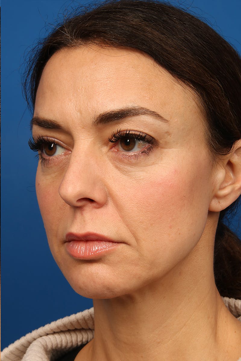 Cheeks Before & After Gallery - Patient 170223 - Image 7