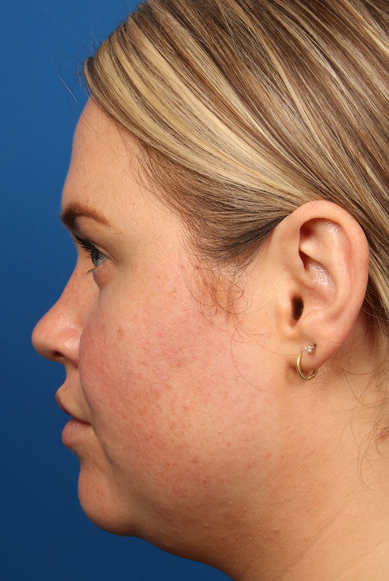Tear Troughs Before & After Gallery - Patient 216553 - Image 9