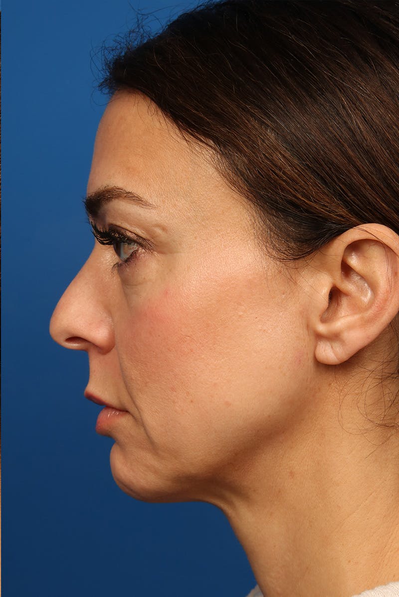 Cheeks Before & After Gallery - Patient 170223 - Image 9