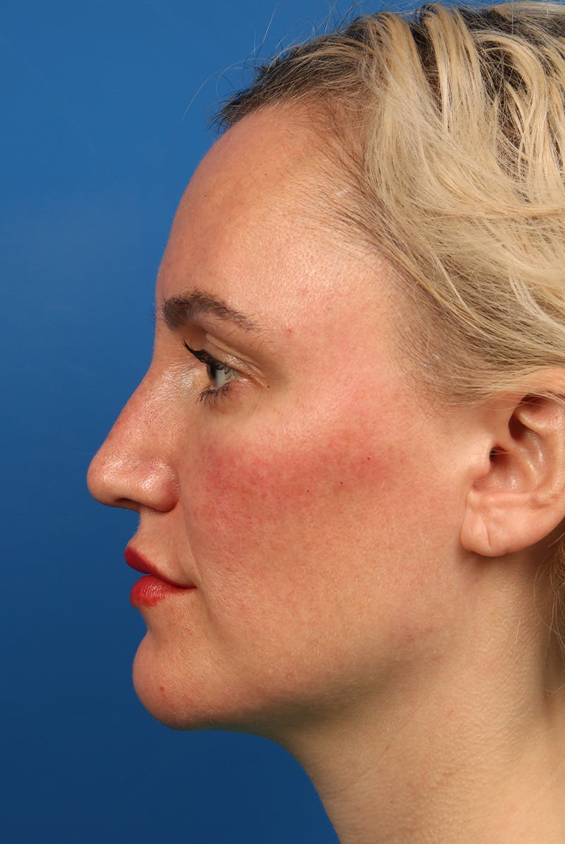 Nose Before & After Gallery - Patient 463536 - Image 10