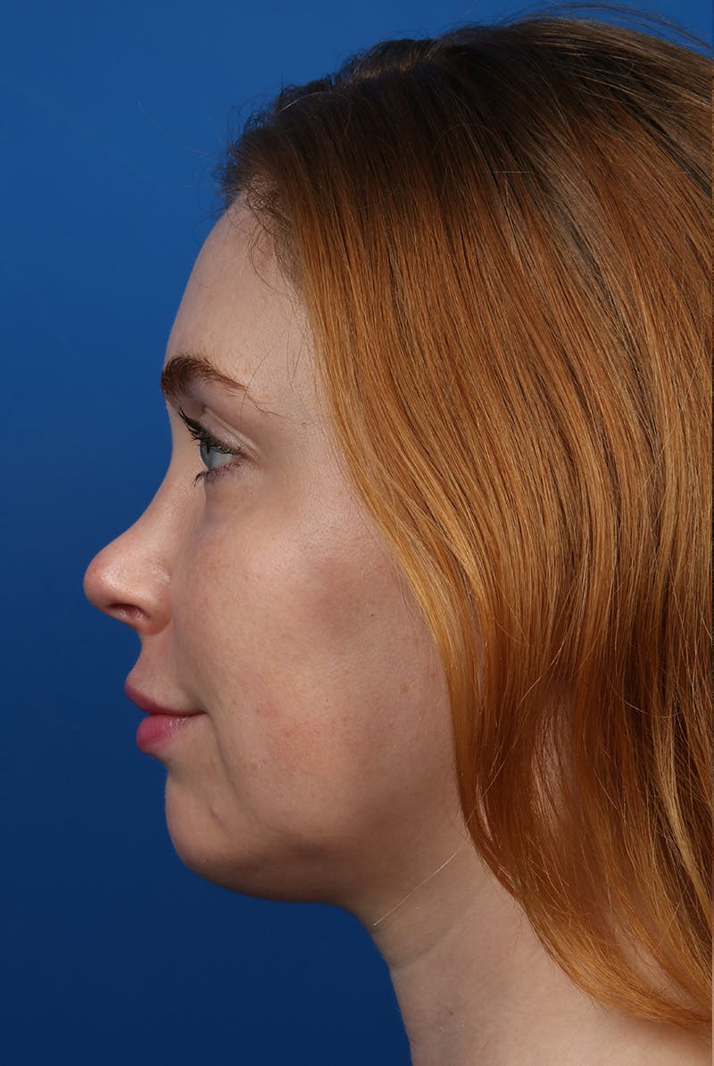 Jawline Before & After Gallery - Patient 129280 - Image 10